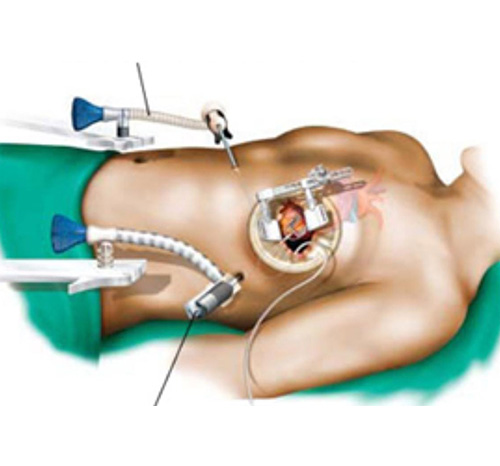 Best Coronary Artery Bypass Graft Surgeon In Thane West