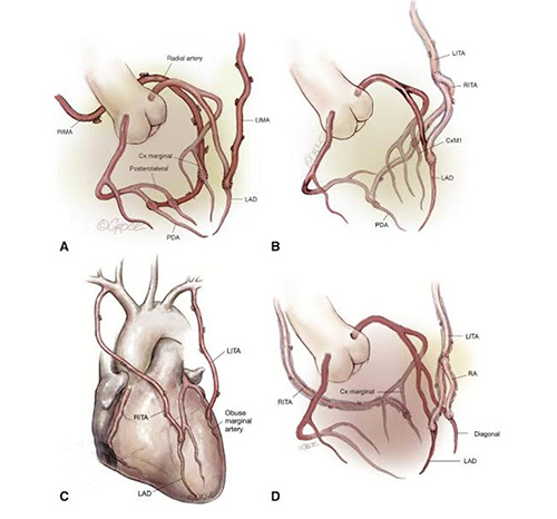 Best Total Arterial Revascularisation Surgeon In Thane West